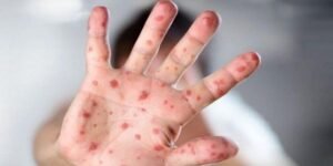 সিলেটে হামের উপসর্গ নিয়ে আরও ২ শিশুর মৃত্যু